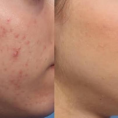 Anti Acne Treatment